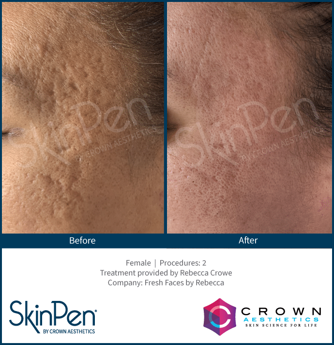 Microneedling Burleson, TX Before & After Image