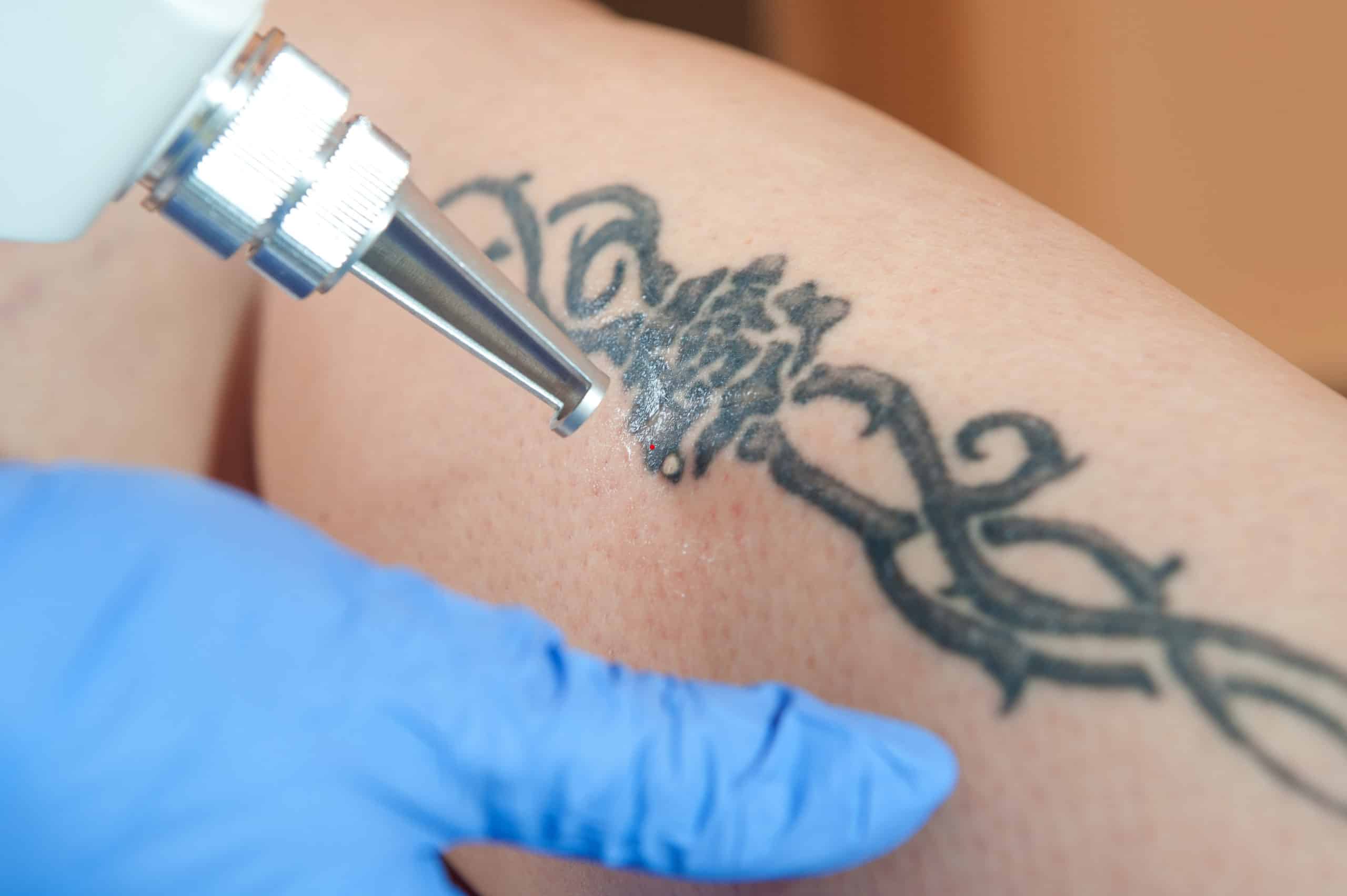 Laser Tattoo Removal Brynmill Swansea - Cowell St Skin & Hair Clinic
