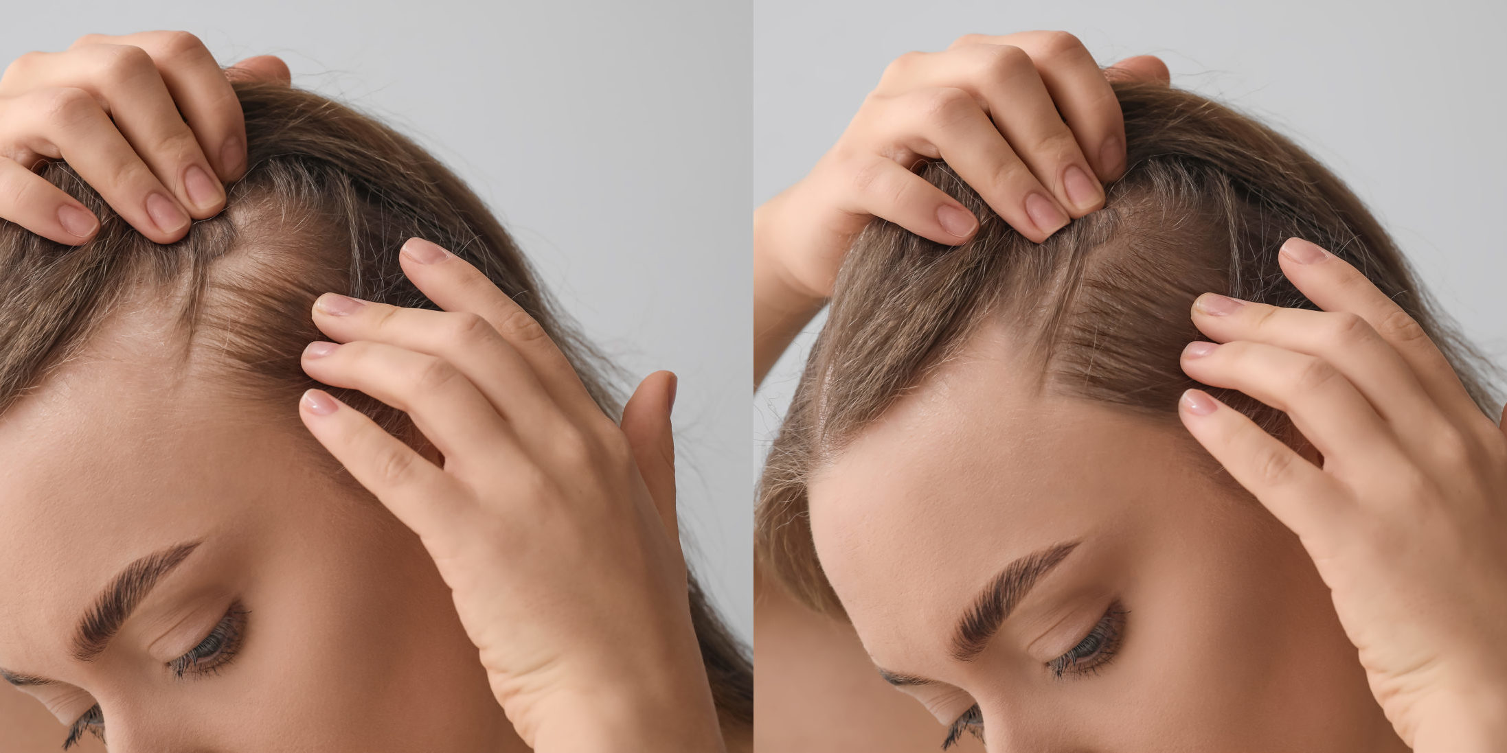 Common Causes of Hair Loss in Women