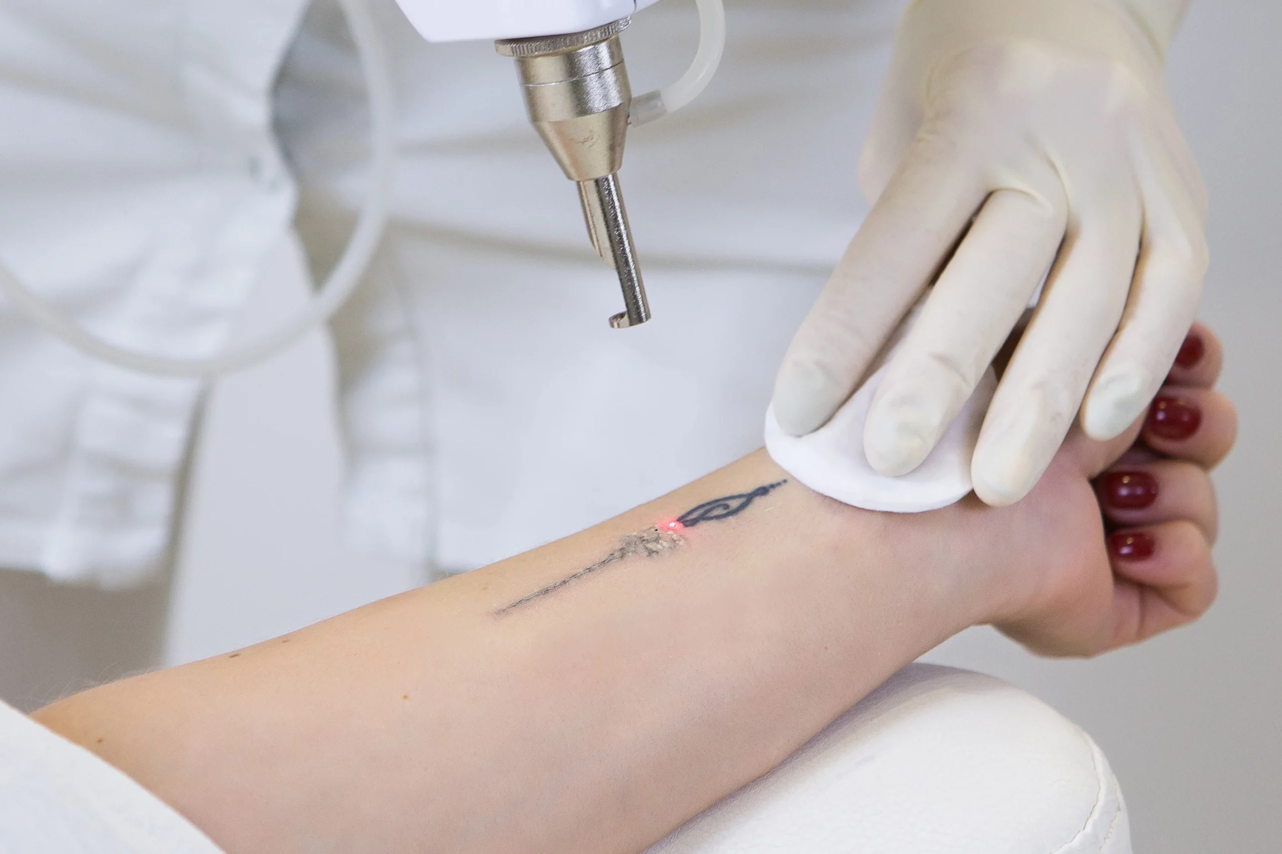 Laser Tattoo Removal by belle visage medical aesthetics in burleson tx