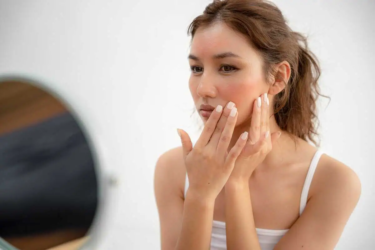 Acne Treatment at Belle Visage