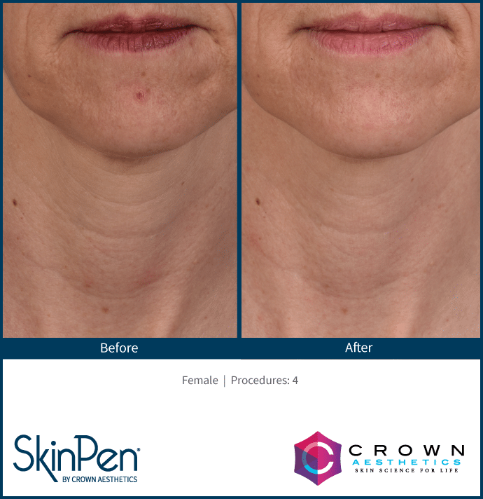 Microneedling Burleson, TX Before & After Image
