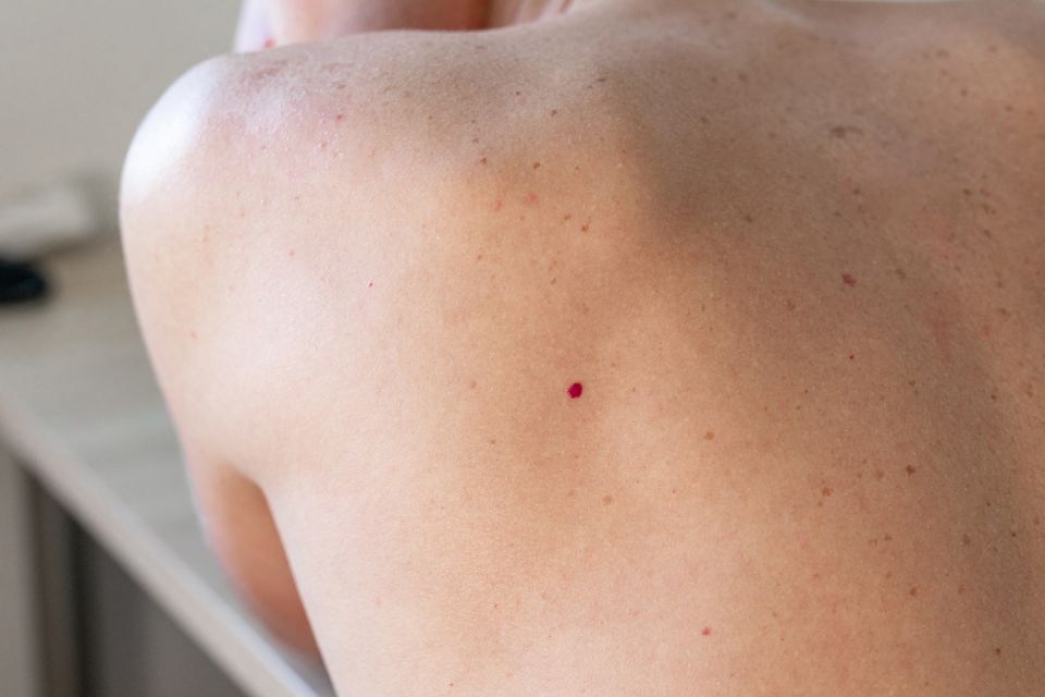 Cherry Angioma or Red Spot Treatment